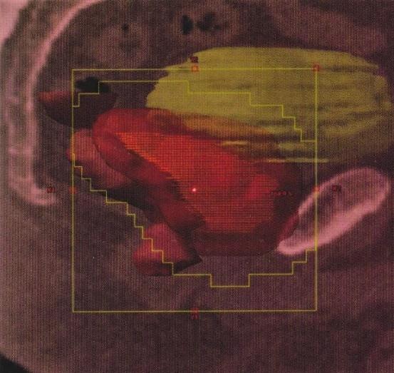 V 80. letech 20.století byla zavedena počítačová technika, která poskytla možnost využít výpočetní tomografii v plánování, a tudíž i jeho zlepšení.