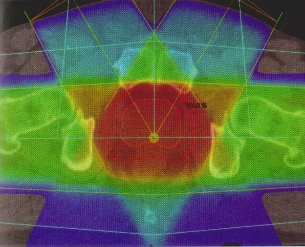 Obrázek 11 Plánování 3D-CRT v transverzálním řezu 11 Radioterapie s modulovanou intenzitou svazku (IMRT) Vyvinutější formou trojrozměrné konformní terapie je radioterapie s modulovanou intenzitou