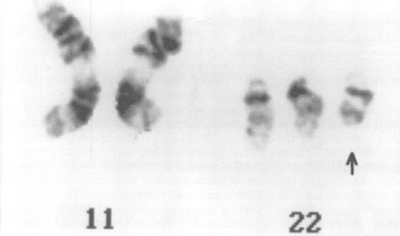 Obrázek 7: G pruhovací technikou lze vidět derivovaný chromozom 22 označený šipkou (převzato z Dawson et al., 1996).