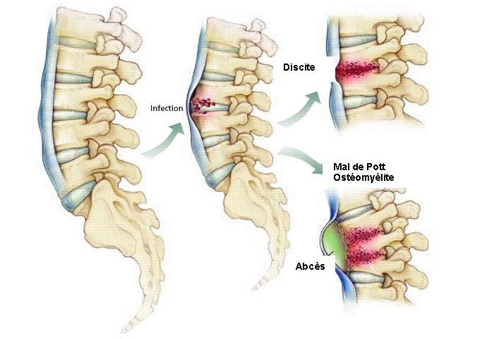 Vývoj hnisavých onemocnění páteře www.