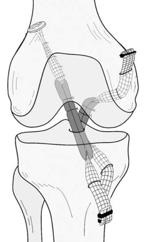 interferenčními šrouby. U štěpů ze šlachy m. semitendinosus a m. gracilis se provádí femorální fixace vstřebatelnými interferenčními šrouby.