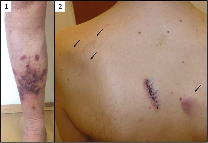 Obr. 1. CTCL. 1) Mycosis fungoides na L hýždi, projevy charakteru splývajících skvrn a plaků (T1b). 2) Mycosis fungoides s rozsáhlým postižením kůže, infiltrovaná ložiska a tumory (T3).