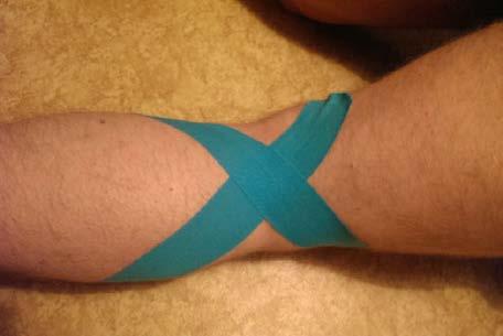 Obrázek 25 - Kineziotaping - zpevňující tape.