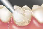 fluoridů Admira Protect v praktickém balení SingleDose Jednoduché, rychlé a hygienické Nejsou nutné další pomůcky Nevylije se