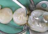 Kompatibilní se všemi konvenčními vazebnými prostředky Klinický případ 300% radiopacity REF 2810 REF 2811 REF 9301 20 sec light-curing 84 % w/w shrinkage 1.