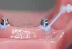 Použití Implantát s nasazenými attachmenty Kontrola přesnosti attachmentů pomocí Fit Test C & B Baze snímatelné