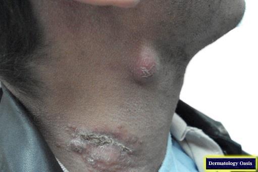 Primární chronické bakteriální kožní infekce Actinomycosis Actinomyces israelii Chronické