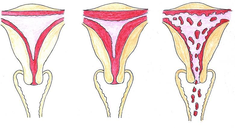 Příčinami chronického krvácení v gynekologii jsou nejčastěji silná menstruační