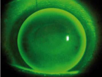 Fluoresceinové zabarvení obvodového pásu ukazuje volnost okraje čočky, jeho šířka a jas udává mnoţství slz kolem okraje.
