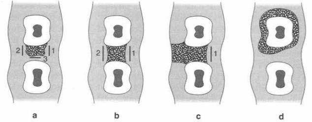 Obrázek 10 - Rozdělení kostních defektů Převzato z: [18] d) Dle hloubky dělíme parodontální kapsy na: 1. mělké - do 5,5 mm, 2. středně hluboké - 5,5 až 8,5 mm, 3. hluboké - nad 8,5 mm [28].