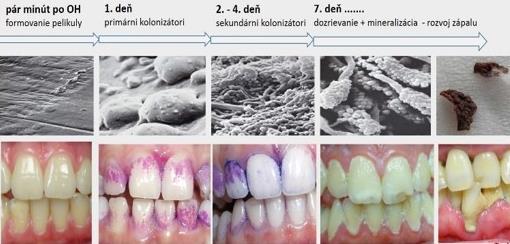 (Actinomyces naeslundii, Actinomyces viscosus), z řad G+ tyček nesmíme opomenout ani Corynebacterium, dále zde nacházíme G- koky (Veilonella, Neisseria) a stejně tak i G- tyčky (rod Bacteroides) [22].
