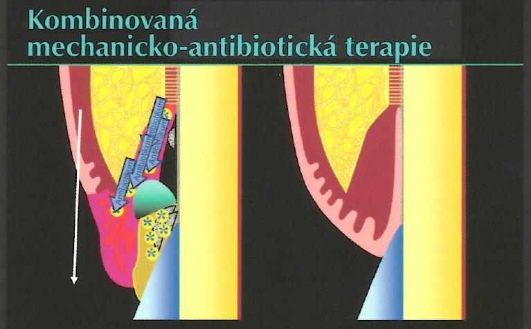 Obrázek 28 - Kombinovaná mechanicko-atb terapie parodontální léze, jež je infikována Aa Převzato z: [26] 3.9.