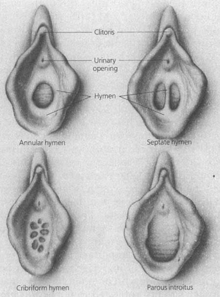 Panenská blána: (hymen) Hymen je tenká zdvojená slizniční řasa, která překrývá vchod poševní a neúplně jej uzavírá Defloratio