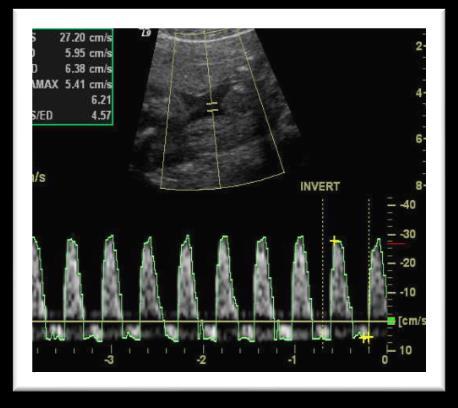 standard: Umbilikální arterie +