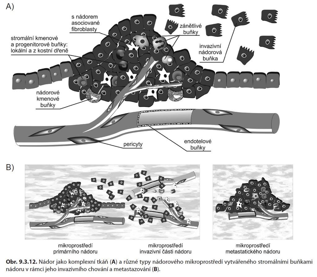 Histologická skladba nádoru nádor je komplexní tkáň Nádorové stroma mezenchymální tkáňové složky: cévní komponenty, podpůrné mezenchymální tkáně, lymfocyty, makrofágy,.
