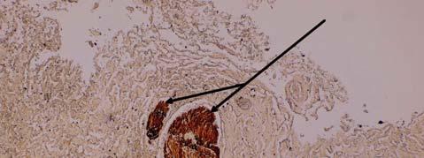 2 Imunohistopozitiva proteinu neurofilament (sytě