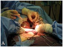 manévr. Játra uvolněna ze závěsů při falx fibrosa hepatis, proťato omentum minus, zpřístupněna vena cava inferior (VCI) nad játry. Preparujeme v.