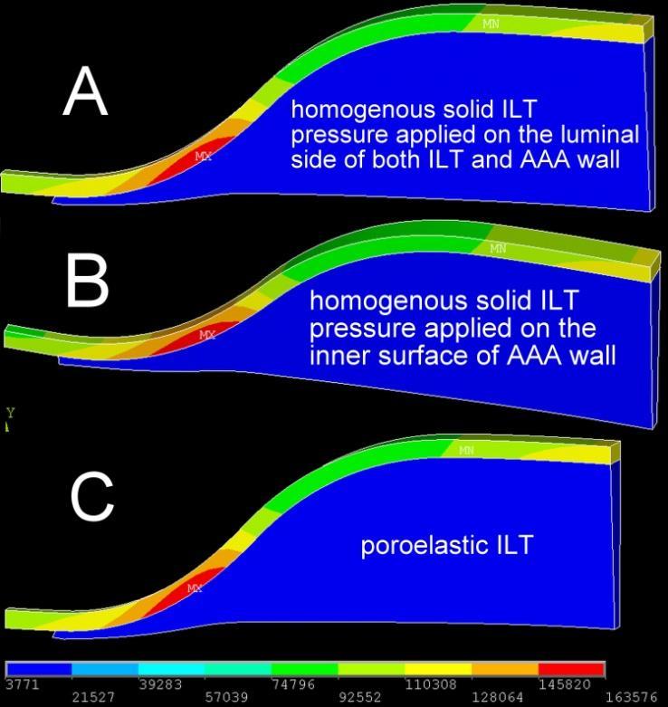 To demonstrate the stress reduction caused by the presence of the ILT one can compare the results in Fig 5 with the case where the ILT was not included (Fig 4). The peak stress reduction is about 55%.