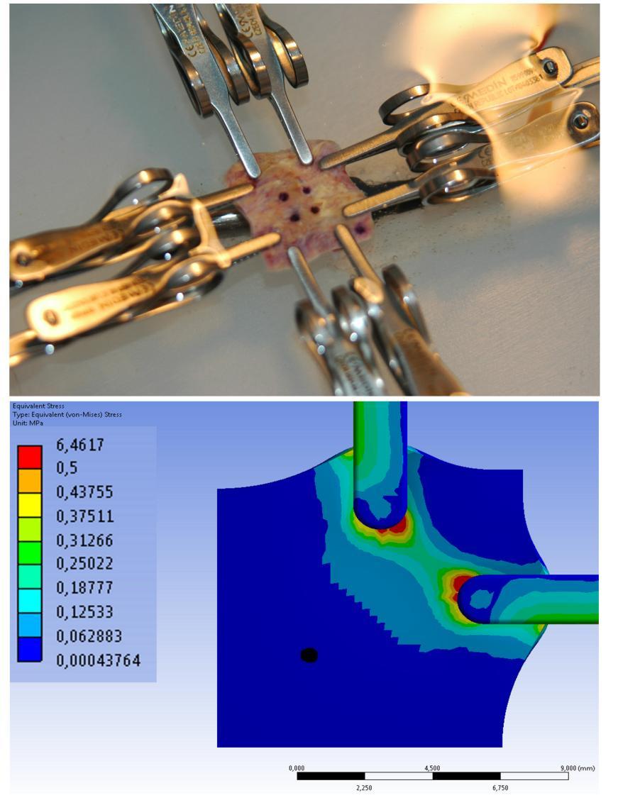 Appendix G: Importance of material model in wall stress prediction in AAAs Figure1: Abdominal Aortic Aneurysm (AAA) wall specimen located in the planar biaxial testing system and immersed in