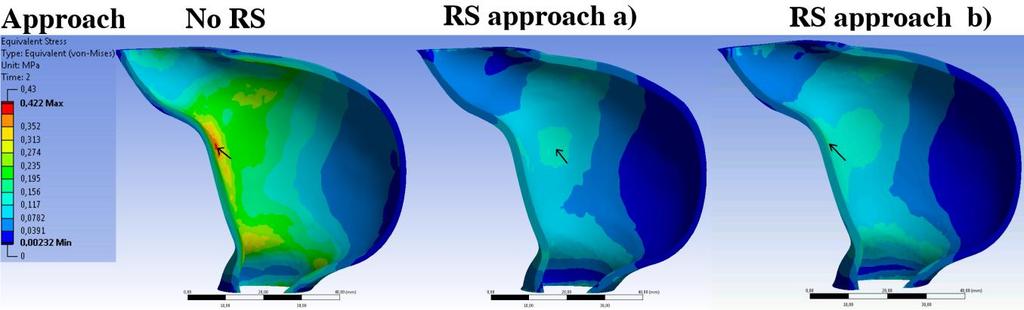 Appendix H: A numerical implementation for prediction of residual strains in AAAs Accounting for RS in the load-free configuration with either approach (a) or approach (b) lead to a homogenized wall