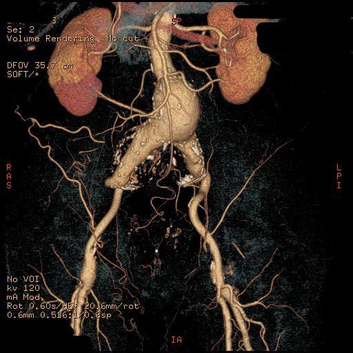 S.Polzer. Stress-strain analysis of aortic aneurysms. Ph.D.Thesis measurements estimate their Young modulus to be in order of GPa 32.