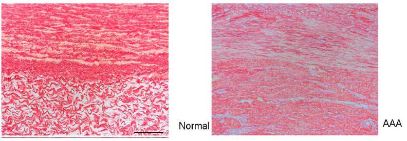S.Polzer. Stress-strain analysis of aortic aneurysms. Ph.D.