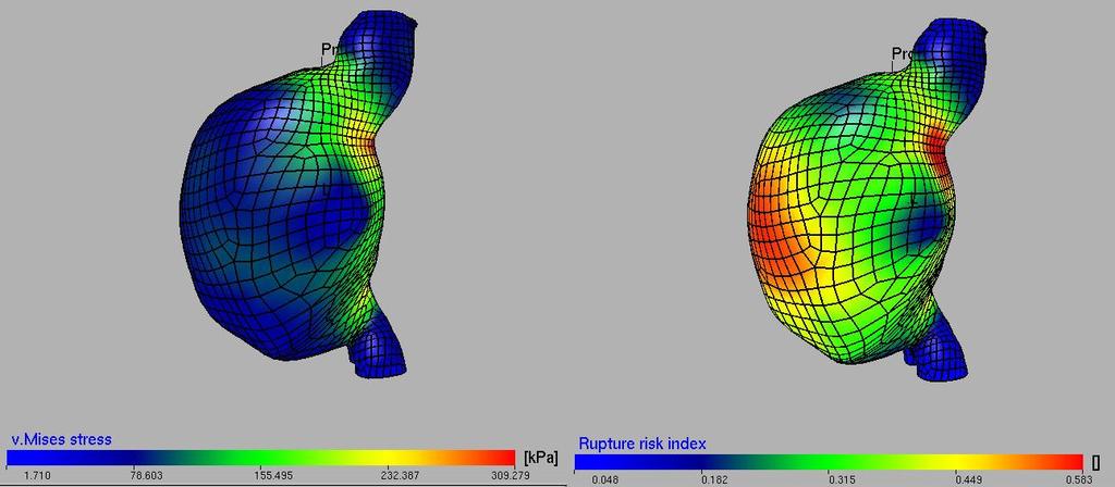 S.Polzer. Stress-strain analysis of aortic aneurysms. Ph.D.Thesis change locally when calcifications are present 34.
