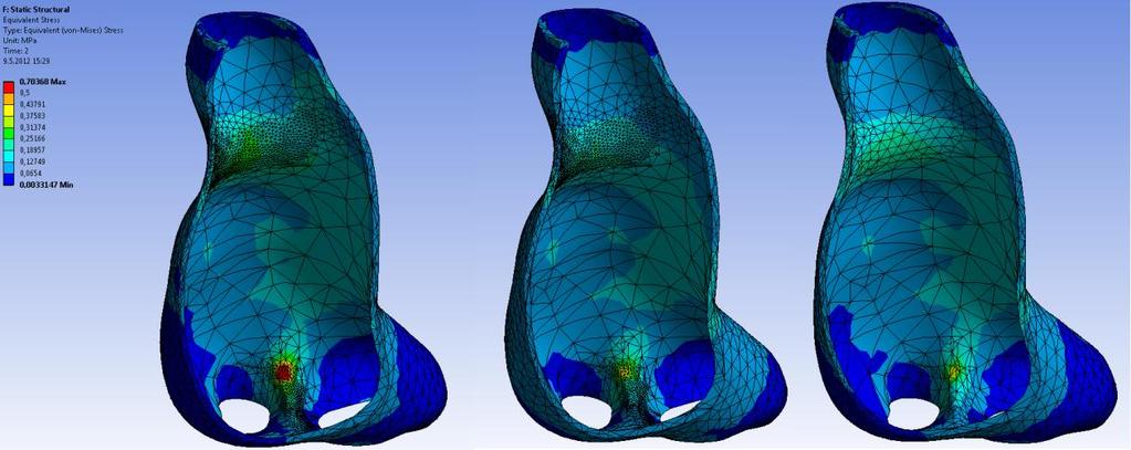 S.Polzer. Stress-strain analysis of aortic aneurysms. Ph.D.Thesis the wall here.