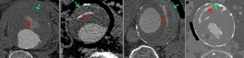Appendix A: The impact of ILT failure on the mechanical stress in AAA. out of plane resolutions of 1.0 mm and 0.6-:-2.0 mm, respectively was used for CT-A.
