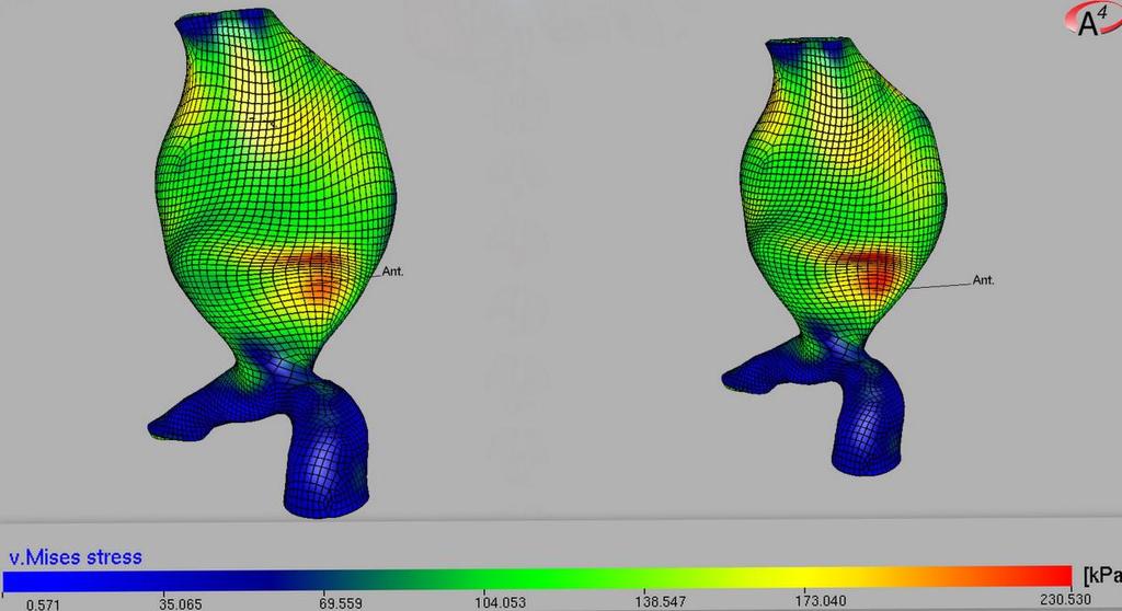 Appendix A: The impact of ILT failure on the mechanical stress in AAA. Figure 2: Wall (von Mises) stress distribution for AAA No.3. with the intact (left) and fissured (right) ILT model.