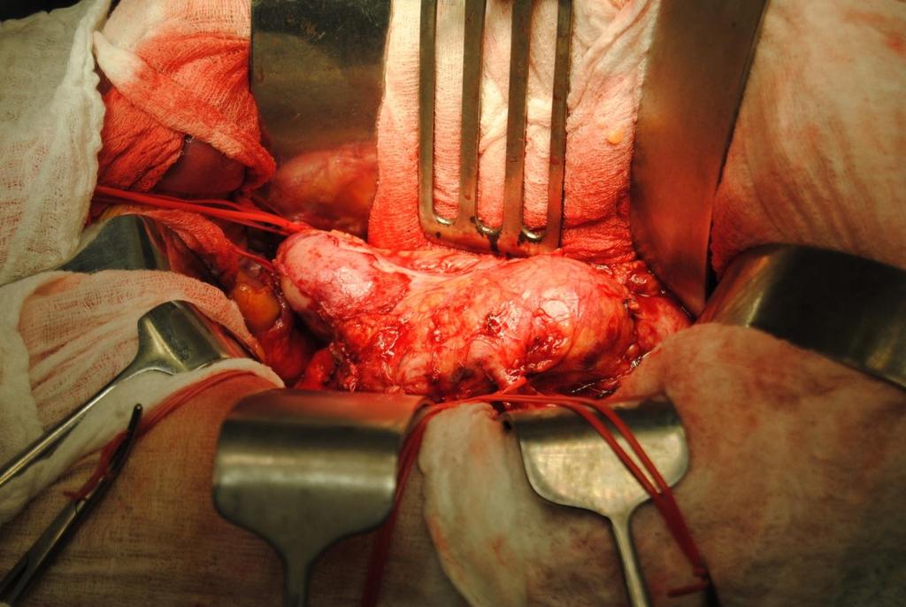 S.Polzer. Stress-strain analysis of aortic aneurysms. Ph.D.Thesis 2 Definition of aneurysm There are several definitions of what is aneurysm 31.