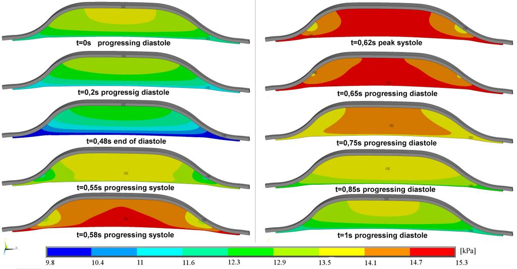 Appendix B: Impact of poroelasticity of ILT on wall stress of AAA 97 Figure 4 Typical evolution of pore pressure during cardiac cycle; plotted for AAA60 and F k 12 4-1 -1 10 m N s.