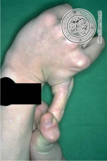 hyperextenzibilita pokožky http://www.meddean.luc.