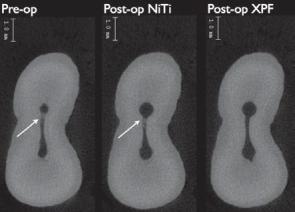 Klinický případ Mikrotomograﬁe distálního a meziálního kořene dolního moláru instrumentovaného na 35/.