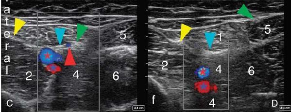 ADDUCTOR CANAL BLOCK C, Midway along the VAM where the saphenous nerve has penetrated the VAM and lies in the subsartorial space superficial to the VAM adjacent to the descending genicular artery.