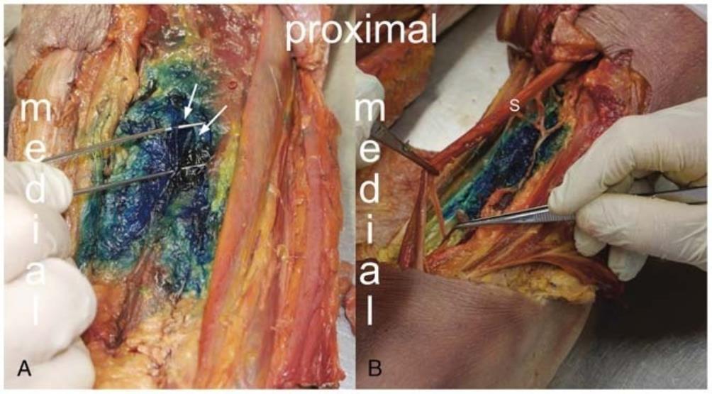 DISTÁLNÍ ADDUCTOR CANAL BLOCK Spread of methylene blue from the AC through the adductor hiatus into the popliteal fossa.