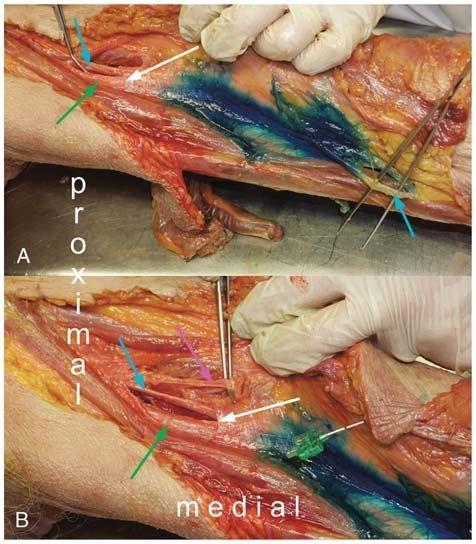 DISTÁLNÍ ADDUCTOR CANAL BLOCK Proximal spread of methylene blue after injection into the AC.