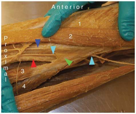 adductor longus a magnus Anteromediálně: membrana