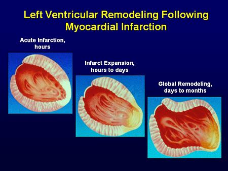 Remodelace LK po IM Akutní IM, hodiny Rozvoj infarktového