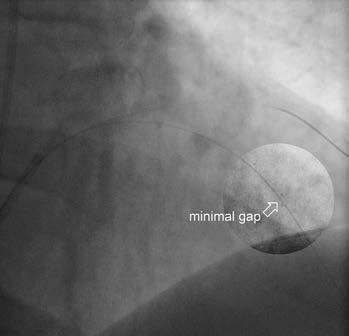 Tab. 1. Techniky implantace dvou a více BVS. Schémata použita se svolením firmy Abbott Vascular Schéma Označení Výsledný překryv BVS dvojnásobek oproti aktuálním DES).