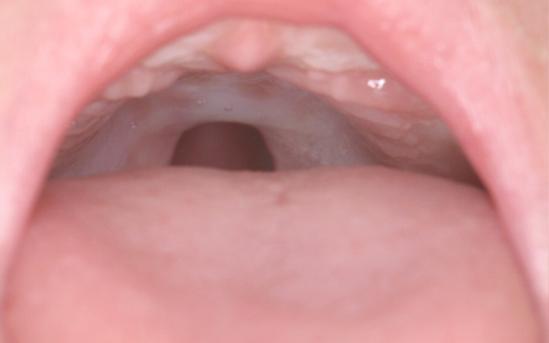 Můţe být prezentovaný zářezem do alveolárního výběţku či jeho defektem zasahujícím aţ po foramen incisivum. Podle šířky rozštěpové štěrbiny je různě vyjádřená i deformace nosu.