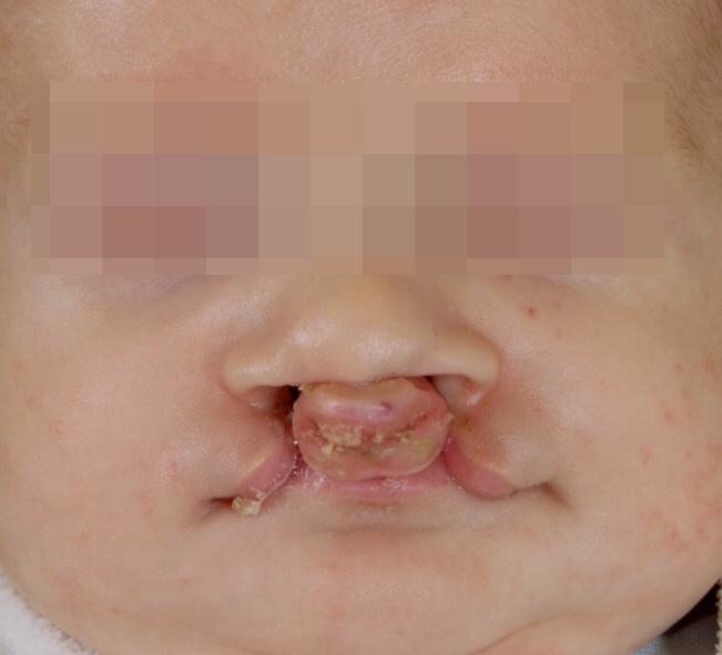 Podle velikosti rozštěpu je různě vyjádřeno postiţení nosu.