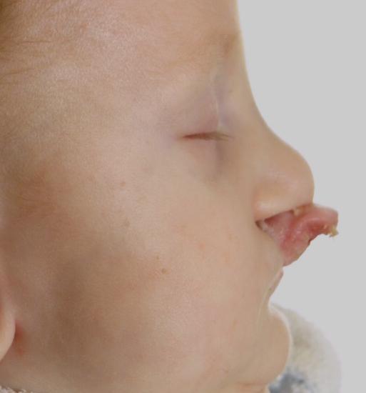 Kolumela a nosní septum jsou nakloněny do rozštěpové mezery s bází deviovanou k nepostiţené straně. Další deformace je důsledkem kontrakce musculus orbicularis oris v menším segmentu. Obr.
