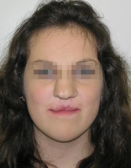 Výrazné zkrácení délky maxily, její dorzální pozice, zúţení dentoalveolárního oblouku a palatinální dentoalveolární inklinace, které nalézáme u pacientů s