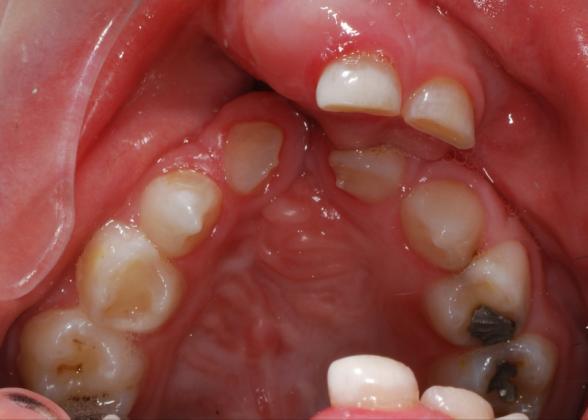 se zpravidla odstraňují během chirurgické rekonstrukce alveolárního výběţku (viz kapitola 3.8.1.3.). Typické je stěsnání ve stálém chrupu a to jak v menším, tak i ve větším čelistním segmentu.