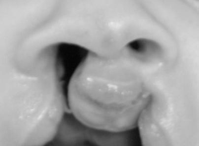 Nasoalveolární molding se pouţívá v různých modifikacích v indikovaných případech u pacientů s jednostrannými a oboustrannými celkovými rozštěpy i na Oddělení ortodoncie a rozštěpových vad FNKV s