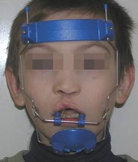 Ve smíšené dentici jsou částečně vyuţívány snímací aparáty, pro terapii zásadní jsou však fixní ortodontické aparáty a patrové oblouky různého rozsahu [125].