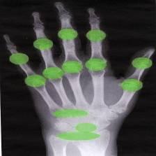 Další 2 klinické studie u OA kloubů prstů ruky prokázaly, že progrese onemocnění byla u pacientů léčených chondroitinsulfátem pomalejší a u méně pacientů se v této skupině rozvinula erozivní OA 12-13.