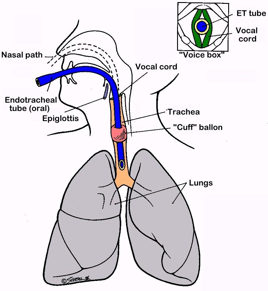 Intubace Zavedení tracheální