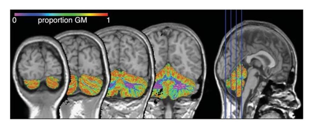 Three-dimensional fast field echo scan Zeeuw P et al,